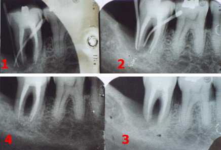 Piorrea: ricrescita ossea